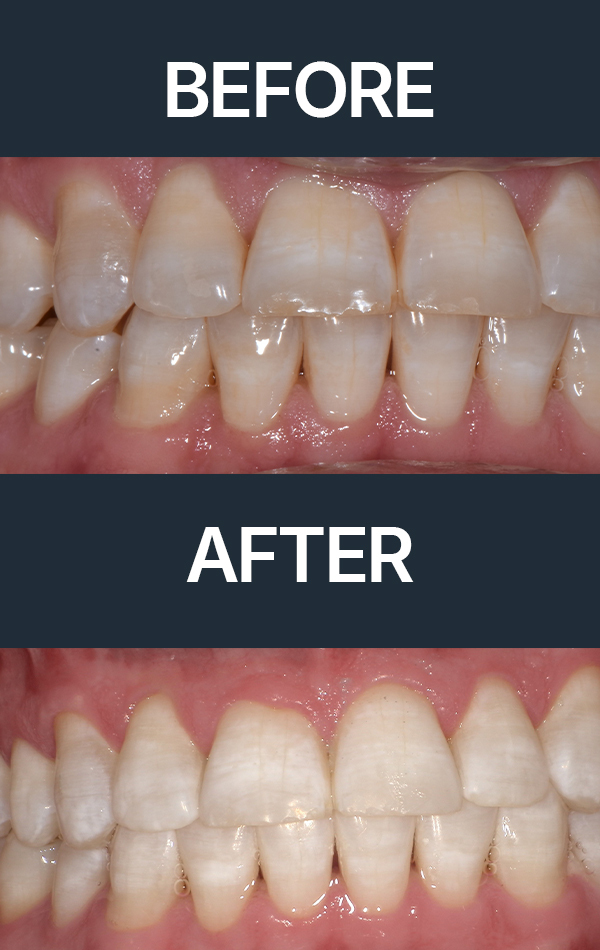 Teeth Whitening Boynton Beach, FL Teeth Whitening Boynton Beach, FL